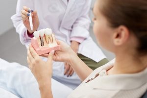 Questions About Dental Implant