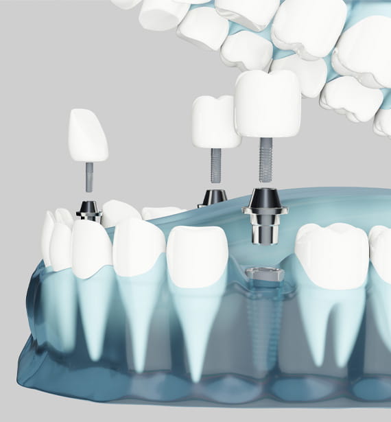 Zirconia Dental Implants
