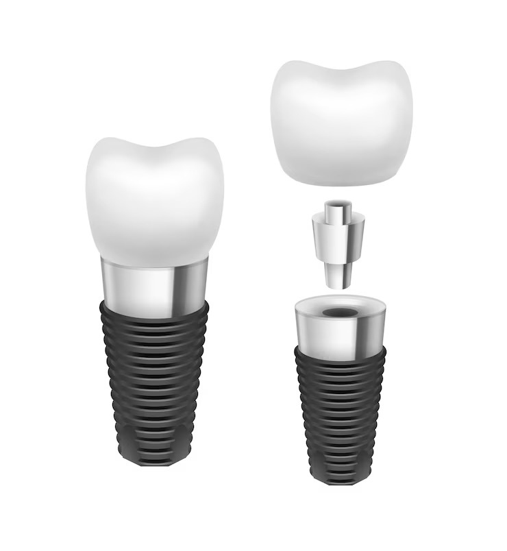 Vancouver Dental Implant