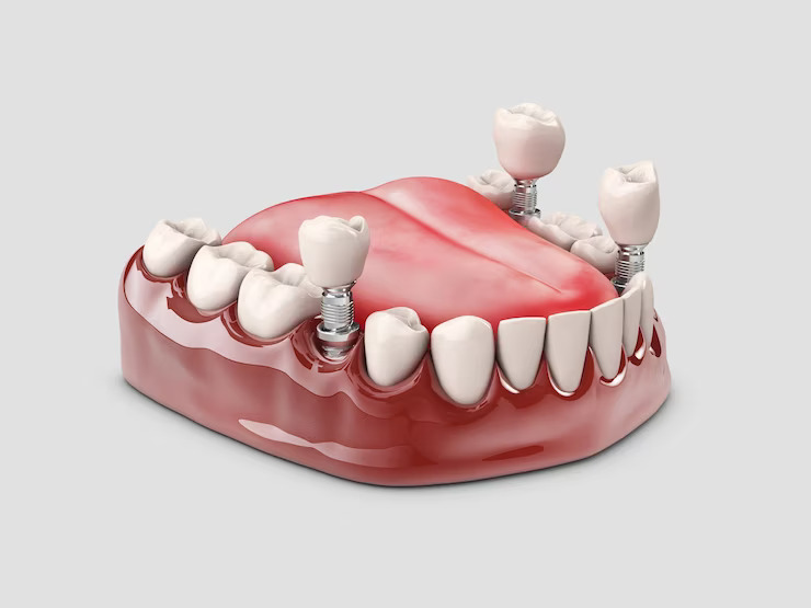 The Insurance Coverage for Dental Implant Surgery in Vancouver
