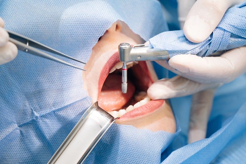How Can Patients Mentally Prepare Themselves for Implant Surgery?