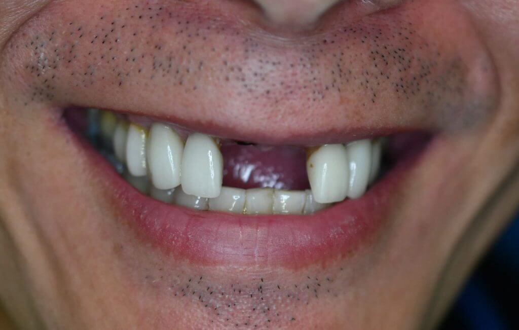 dental implant vancouver