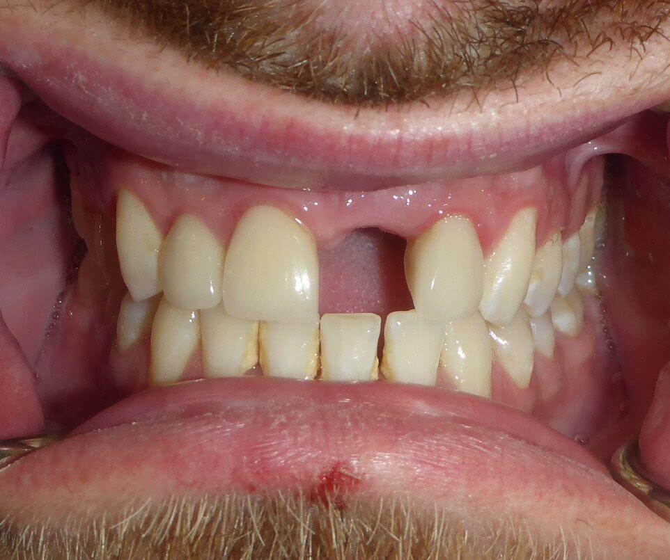 dental implant vancouver