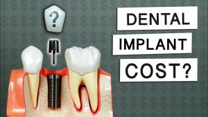 Factors Affect Price of Dental Implants