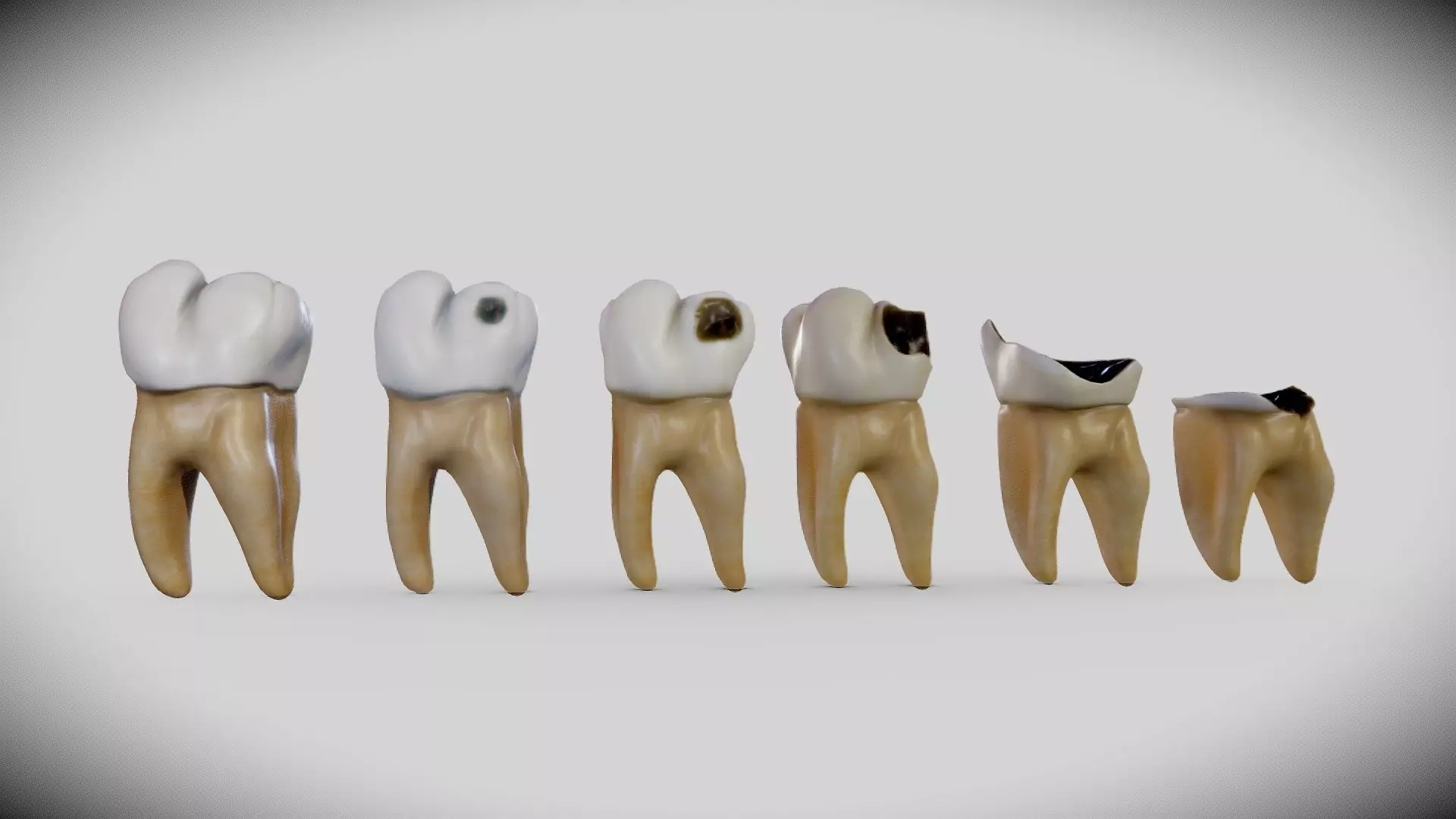 tooth-decay-and-cavities