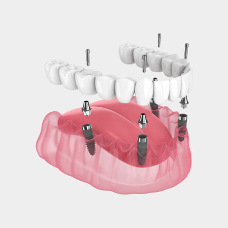 All-on-4 Dental Implants in Vancouver