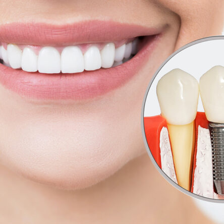 Understanding Dental Implant Cost in Vancouver