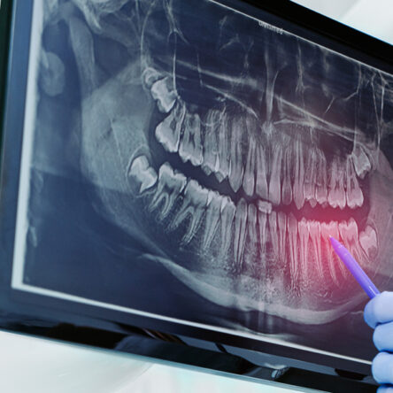 Dental Implants in Vancouver
