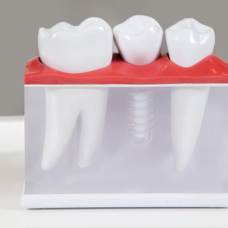 Mini Dental Implants in Vancouver
