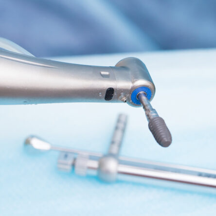 Titanium Dental Implants in Vancouver