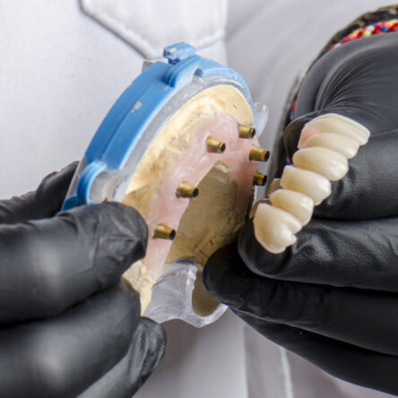 Zirconia Dental Implants in Vancouver