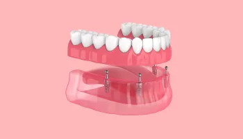 Why All-on-4 Dental Implants Are the Fastest Way to Restore a Full Smile in Vancouver?