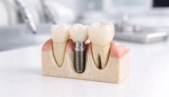 Can Dental Implants Be Done Right After Tooth Loss? Immediate Emergency Implant Guide