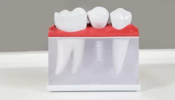 Why Mini Dental Implants Are Gaining Popularity in Vancouver?