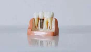 Are Same-Day Dental Implants Safe? Vancouver Dentists Explain the Process