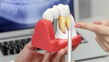 Evaluating the Success Rate of Immediate Dental Implants