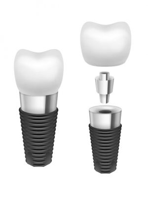Vancouver Dental Implant