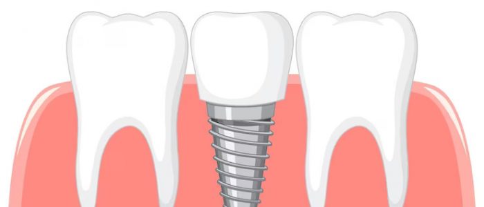 Titanium Dental Implants
Dental Implant FAQ